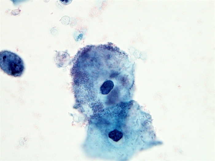 <strong>A 32-year-old woman, gravida 1 para 1, comes to the office for vaginal discharge.  The patient has no chronic medical conditions and takes no daily medications.  Her last menstrual period was 3 weeks ago.  The patient has recently become sexually active with a new partner and uses an intrauterine device for contraception.  Cytology of the discharge is shown in the image below:   Which of the following best describes the predominant organism causing this patient's condition?</strong> A)Anaerobic gram-variable rod B)Diploid fungus C)Gram-negative diplococcus D)Intracellular gram-negative bacterium E)Motile protozoan F)Naked DNA virus <div style=padding-top: 35px> 