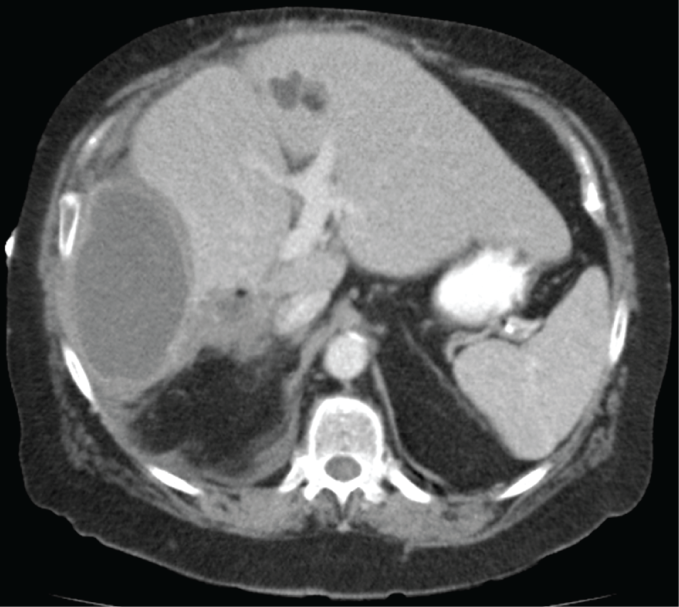 A 57-year-old woman is hospitalized with high-grade fevers, chills, and right upper abdominal pain.  The patient lives in Wisconsin and has no history of international travel.  Her temperature is 40 C (104 F) .  Physical examination of the abdomen shows rebound tenderness.  Laboratory studies show elevated aspartate and alanine aminotransferases.  Imaging studies reveal a fluid-filled cavity within the right lobe of the liver as shown below.   Which of the following microorganism/route combinations is most likely to be the cause of this patient's infection? A) Chlamydia trachomatis due to ascending cholangitis B) Cytomegalovirus by direct invasion from a nearby source C) Entamoeba histolytica due to a penetrating stab wound D) Staphylococcus aureus by hematogenous route E) Streptococcus pneumoniae by portal vein