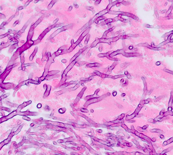 A 47-year-old man comes to the office due to persistent fever, night sweats, and fatigue.  Thorough evaluation yields a diagnosis of chronic myeloid leukemia.  While undergoing treatment for his malignancy, the patient experiences headaches, scant nasal discharge, and left eye symptoms.  Physical examination reveals tenderness over the paranasal sinuses and left-sided orbital swelling and cellulitis.  Mild proptosis and ptosis of the left eye are also present.  Biopsy of the sinus mucosa is shown in the image below:   Which of the following is the most likely cause of this patient's condition? A) Aspergillus fumigatus B) Blastomyces dermatitidis C) Candida albicans D) Coccidioides immitis E) Cryptococcus neoformans F) Histoplasma capsulatum G) Malassezia furfur H) Microsporum canis I) Rhizopus species J) Sporothrix schenckii