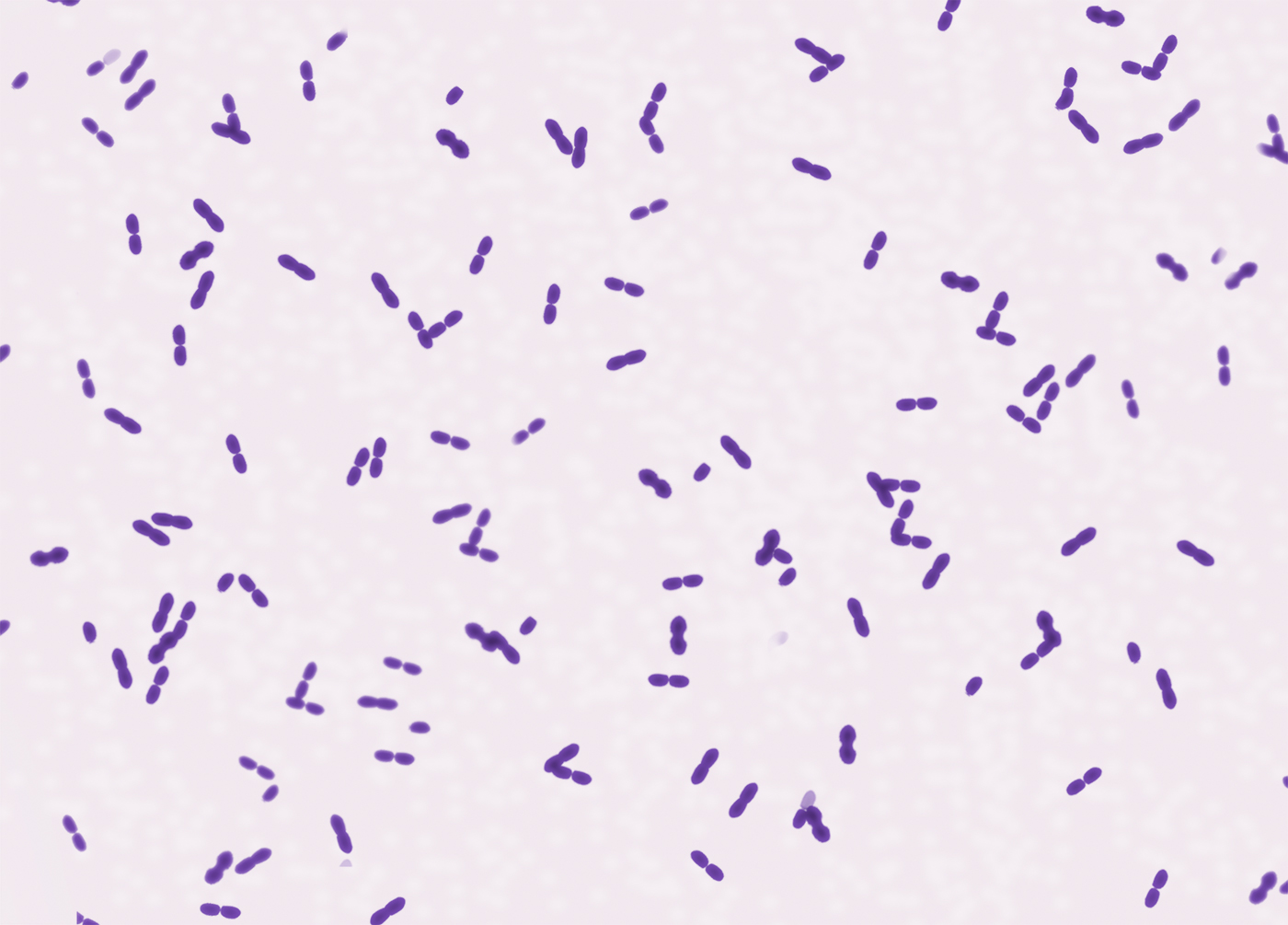 A 40-year-old woman comes to the emergency department due to malaise, fever, productive cough, and pleuritic chest pain.  The patient has a history of alcohol use disorder and HIV acquired from injection drug use.  She is nonadherent with antiretroviral therapy and other HIV-related medications.  Temperature is 38.3 C (101 F) , blood pressure is 120/72 mm Hg, and pulse is 104/min.  Lung examination reveals bronchial breath sounds and crackles.  Sputum microscopy findings are shown below.   Which of the following pathogenic factors most likely contributes to this microorganism's ability to cause lung infection? A) Alveolar hyaline membrane formation B) Antiphagocytic microbial capsule C) Endotoxin-induced cell necrosis D) Intracytoplasmic location of the organism E) Lipid-rich microbial cell wall