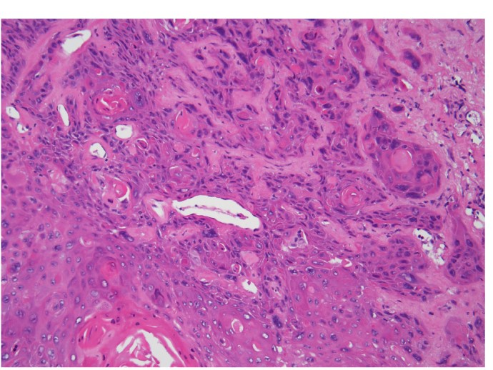 A 45-year-old man comes to the office due to a sore throat for the past 3 months.  The patient also has pain with swallowing.  He has never smoked, drinks alcohol occasionally, and does not use illicit drugs.  On physical examination, the right tonsil is enlarged with a small area of ulceration.  The rest of the physical examination is unremarkable.  Biopsy of the right tonsil is shown in the image below:   Which of the following most likely played the most significant role in the pathogenesis of this patient's condition? A) Coxsackievirus B) Epstein-Barr virus C) Herpes simplex virus D) Human immunodeficiency virus E) Human papilloma virus