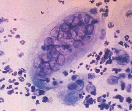 A 4-year-old boy is brought to the office with 3 days of fever, irritability, and oral lesions.  His parents are concerned due to his refusal to eat or drink and lack of urination today.  Physical examination demonstrates painful ulcers on the tongue and gingiva, swollen gums, and cervical lymphadenopathy.  The remainder of his examination is unremarkable.  Microscopic examination of an oral ulcer base scraping is shown in the image below.   Which of the following is most likely the cause of this patient's condition? A) Abortive infection B) Latent infection C) Primary infection D) Slow virus infection E) Virus reactivation