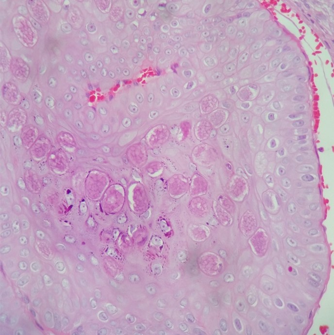 A 43-year-old, HIV-positive woman comes to the office due to lesions on her vulvar and perineal areas for the past 4 weeks.  On examination, there are clusters of firm, shiny, round papules that are each 2-6 mm in diameter with central indentation.  Microscopic examination of a lesion is shown in the image below:   Which of the following is the most likely cause of this patient's presenting condition? A) Herpes simplex virus B) Human herpesvirus 8 C) Human papillomavirus D) Poxvirus E) Treponema pallidum