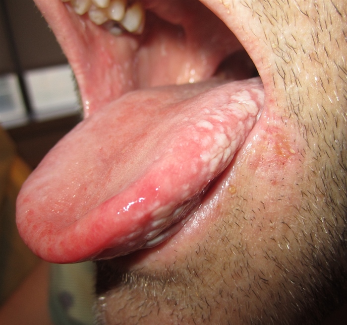 A 31-year-old man comes to the office due to oral lesions that cause occasional discomfort during eating.  He also reports fatigue and unintentional weight loss.  The patient has no prior medical problems and takes no medications.  Oral examination findings are shown below.   The lesions can be easily scraped off, revealing erythematous mucosa underneath.  There are several enlarged cervical and axillary lymph nodes.  Which of the following diagnostic tests is most appropriate during further workup of this patient? A) HIV antigen and antibody testing B) Oral lesion biopsy to rule out malignancy C) PCR for coxsackievirus D) Scraping microscopy for multinucleated giant cells E) Serum vitamin B<sub>12</sub> and folate levels