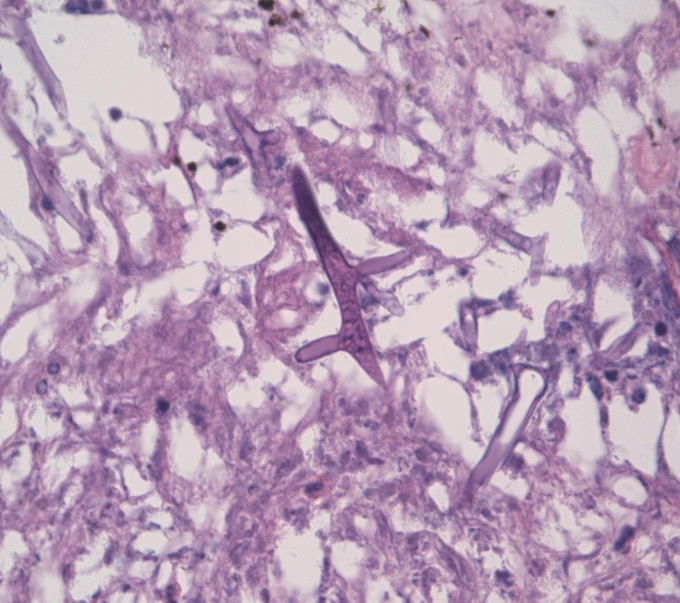A 38-year-old man is undergoing treatment for acute myeloid leukemia.  Initially, he had fevers and reported being lethargic and fatigued all the time.  However, of late, he has noted increasingly severe right-sided headaches.  He describes the pain to be throbbing in nature and located behind his right eye.  He also has associated nasal stuffiness.  The patient has no prior history of allergies.  Physical examination reveals right-sided proptosis and periorbital tenderness.  Biopsy of the right maxillary sinus mucosa reveals the following:   Which of the following is the most likely cause of this patient's condition? A) Malassezia furfur B) Microsporum canis C) Rhizopus species D) Aspergillus fumigatus E) Candida albicans F) Cryptococcus neoformans G) Blastomyces dermatitidis H) Histoplasma capsulatum I) Coccidioides immitis J) Sporothrix schenckii