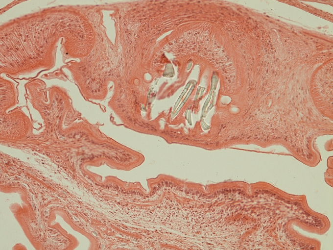 A 33-year-old man is admitted to the hospital due to new-onset seizures.  He has no significant medical history.  Vital signs are normal.  Neurologic examination shows no abnormalities.  CT scan of the head reveals a 3-cm cystic lesion in the temporal lobe.  The mass is excised, and histopathology is shown in the image below:   Which of the following is the most likely diagnosis? A) Helminth infection B) Meningioma C) Metastatic disease D) Protozoal infection E) Tuberculosis