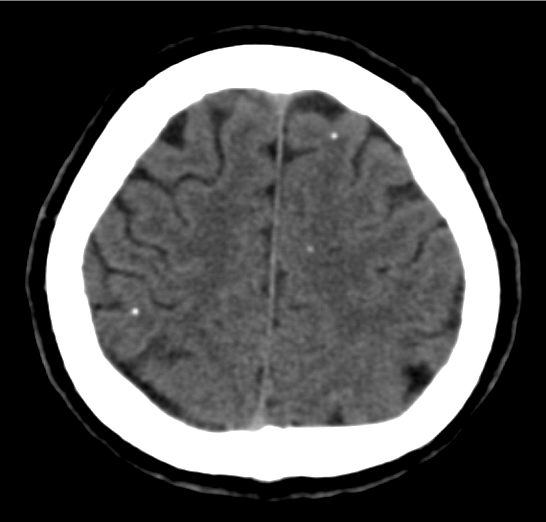 A 27-year-old man is brought to the hospital after having a generalized tonic-clonic seizure an hour ago.  The patient has no chronic medical conditions and takes no medication.  He emigrated from Nicaragua to the United States 5 years ago.  Vital signs are within normal limits.  Complete neurologic examination reveals no abnormalities.  A CT scan of the head is shown in the image below.   Complete blood count and cerebrospinal fluid evaluation are within normal limits.  Which of the following is the most likely diagnosis? A) Cryptococcosis B) Miliary tuberculosis C) Neurocysticercosis D) Neurosyphilis E) Toxoplasmosis