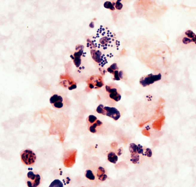 A 22-year-old man comes to the office due to a painful lesion on his upper back.  The patient developed a small tender papule a few days ago that progressively enlarged and became red and painful.  He has had 3 similar lesions on his upper back over the past 6 months, which were treated with incision and drainage and antibiotics.  The patient has no other medical issues and takes no medications.  He does not use tobacco, alcohol, or illicit drugs.  On physical examination, there is a 3-cm tender pustule with surrounding erythema on his right upper back.  Gram staining of purulent drainage from the lesion is shown below.   Which of the following most likely predisposed this patient to recurrent infections? A) Colonization in anterior nares B) Dormant infection in granulomas C) Formation of elementary bodies D) Harborage in epidermal burrows E) Spores from contaminated surfaces