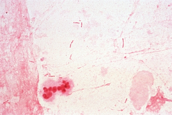 A 65-year-old man is admitted to the intensive care unit with second- and third-degree burns over 25% of his total body surface area.  Intravenous fluids and analgesics are administered, and his wounds are cleaned and debrided.  After 7 days, the patient develops a fever and his leukocyte count rises to 16,000 cells/µL.  Examination of the burns on his left leg shows surrounding warmth, erythema, and induration.  Gram stain of his wound tissue is shown in the image below.   Culture on MacConkey agar grows oxidase-positive colonies that do not ferment lactose.  Which of the following is the best initial treatment for this patient? A) Cefepime B) Ceftriaxone C) Doxycycline D) Moxifloxacin E) Trimethoprim-sulfamethoxazole