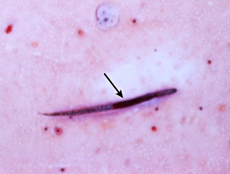 A 25-year-old woman comes to the office due to a week of cough and dyspnea.  She also reports intermittent, crampy abdominal pain and diarrhea.  The patient has no history of respiratory illness or other chronic medical conditions but was recently diagnosed with immune thrombocytopenia that resolved with high-dose glucocorticoid therapy.  She does not use tobacco, alcohol, or illicit drugs.  She immigrated to the eastern United States from Myanmar 8 years ago, but has not travelled recently.  Temperature is 37.2 C (99 F) , blood pressure is 120/78 mm Hg, pulse is 88/min, and respirations are 18/min.  Physical examination shows scattered wheezes and a nontender abdomen.  Laboratory studies reveal eosinophilia, and sputum microscopy is shown in the image below:   This patient most likely acquired the pathogen via which of the following modes of transmission? A) Infected mosquito bite B) Infected tick bite C) Larval skin penetration D) Parasite oocyst ingestion E) Pathogen spore inhalation