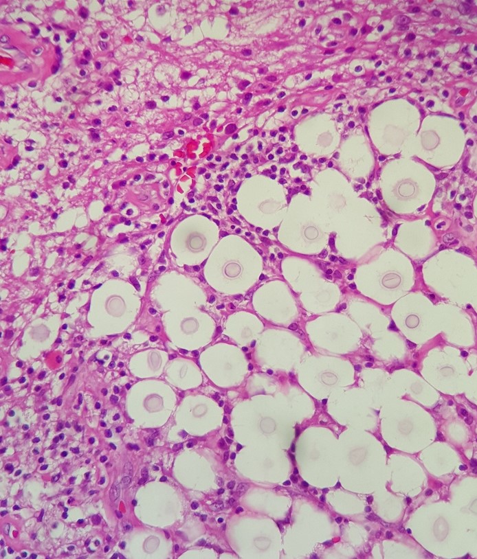 A 38-year-old man is brought to the emergency department after a generalized tonic-clonic seizure.  He had several days of progressive headache, vomiting, and confusion prior to the episode.  Temperature is 38 C (100.4 F) .  Physical examination shows a lethargic patient with bilateral papilledema and neck rigidity.  His condition progressively worsens, and the patient dies in the hospital several days later.  An autopsy is performed, and the brain histopathology is shown below.   Which of the following pathogens is most likely responsible for these findings? A) Bacteria with mycolic acid in cell wall B) Infectious agent lacking nucleic acid C) Neurotrophic double-stranded DNA virus D) Obligate intracellular protozoan parasite E) Yeast with polysaccharide capsule