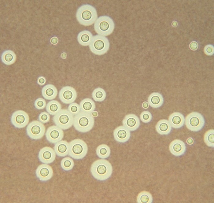 A 28-year-old man comes to the emergency department due to 2 weeks of headaches, fever, and episodes of inattentiveness.  The patient has a history of Hodgkin lymphoma and is undergoing treatment with combination chemotherapy.  Temperature is 38.2 C (100.8 F) , blood pressure is 138/84 mm Hg, and pulse is 72/min.  Lumbar puncture reveals an elevated opening pressure, and cerebrospinal fluid analysis shows moderately increased protein levels and low glucose levels.  Light microscopy of the cerebrospinal fluid is shown in the image.   Which of the following should be included in initial treatment for this patient's current condition? A) Amphotericin B B) Ampicillin C) Ceftriaxone D) Ganciclovir E) Pyrimethamine F) Voriconazole