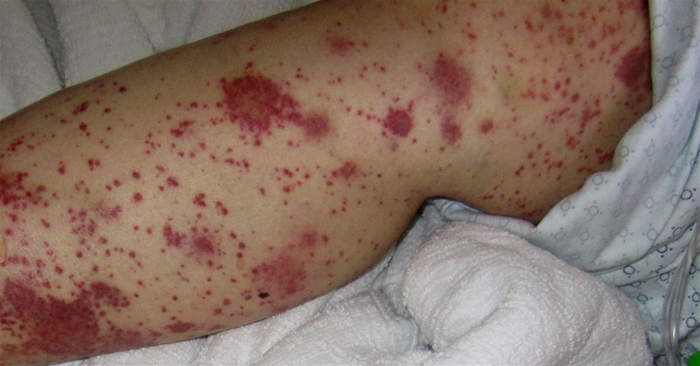 A 22-year-old woman is brought to the emergency department due to a day of fever, headaches, nausea, vomiting, and myalgias that began suddenly last night.  This morning, the patient was lethargic, difficult to arouse, and confused.  She is an exchange student who came to the United States 3 months ago, and her medical history is unknown.  Temperature is 39.4 C (102.9 F) , blood pressure is 100/60 mm Hg, pulse is 112/min, and respirations are 18/min.  Physical examination shows nuchal rigidity.  Skin examination findings are shown in the image.   Leukocyte count is elevated, and lumbar puncture with cerebrospinal fluid Gram stain establishes the diagnosis.  Which of the following is the primary component of the vaccine that could have prevented this patient's current condition? A) Capsular polysaccharide B) Inactivated (killed)  organisms C) Inactivated toxic compounds D) Live attenuated organisms E) Virus-like particles