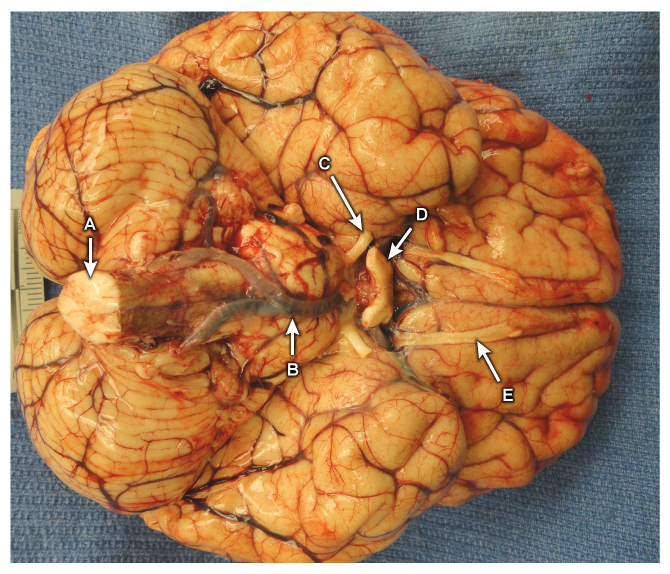 A 24-year-old man is brought to the emergency department due to seizures.  He has had 2 days of worsening fever, headache, and vomiting.  Physical examination shows signs of meningeal irritation.  The patient rapidly becomes comatose and dies 48 hours later despite aggressive medical care.  Autopsy examination shows congested leptomeninges with fibrinopurulent exudate (not shown) .  Microscopy reveals numerous ameba in the exudate and brain tissue.  Which of the following is the most likely portal of entry of this pathogen into the CNS?   A) A B) B C) C D) D E) E
