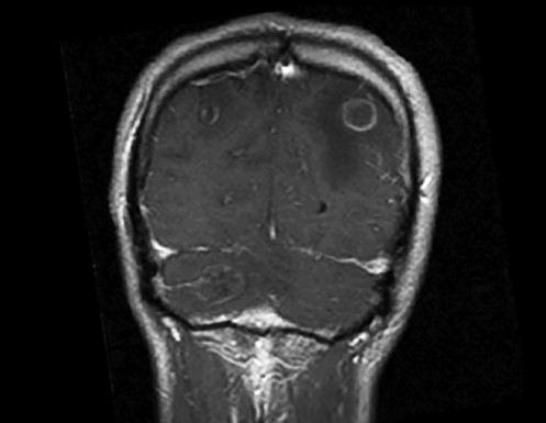 A 42-year-old man is brought to the emergency department following an episode of generalized tonic-clonic seizure witnessed by his family.  He has no prior history of seizure but has had headaches for the past several weeks.  The patient works in construction.  He has no history of travel outside the United States and has never had any pets.  He smokes a pack of cigarettes daily and drinks 3-4 cans of beer every evening.  Physical examination is notable for a postictal state, oral thrush, and several enlarged cervical and inguinal lymph nodes.  An MRI of his brain with contrast is shown in the image below.   Which of the following is the most likely cause of this patient's symptoms? A) Aspergillus fumigatus B) Glioblastoma multiforme C) Mycobacterium tuberculosis D) Neurocysticercosis E) Toxoplasmosis
