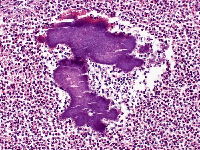 A 55-year-old man comes to the office due to malaise and cough over the past 2 months.  He describes yellow sputum production with occasional streaks of blood.  The patient smokes a pack of cigarettes daily and has a history of alcohol use disorder with prior episodes of binge drinking.  Temperature is 37.1 C (98.8 F) .  Examination shows poor dentition with dental caries, gingivitis, and enlarged submandibular lymph nodes.  Coarse rhonchi are heard during auscultation of the right lung.  Chest CT scan reveals an extensive right lung consolidative process with air bronchograms.  Bronchoscopy is performed, and a lung biopsy specimen shows the findings in the image below.   Which of the following is the most likely diagnosis? A) Actinomycosis B) Adenocarcinoma C) Mucormycosis D) Sarcoidosis E) Tuberculosis