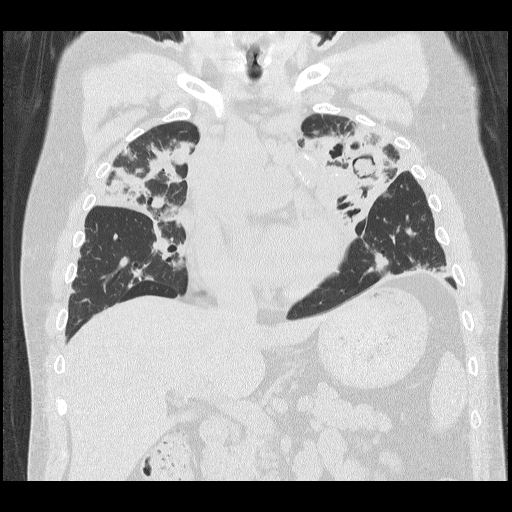 A 65-year-old man comes to the emergency department due to an episode of hemoptysis that occurred earlier this morning.  The patient estimates that he coughed up about 100 mL of blood.  Prior to this episode he was in his usual state of health and felt well, with no fevers, night sweats, or weight loss.  He has had occasional episodes of blood-tinged sputum over the past few months.  The patient's past medical history is significant for tuberculosis (TB)  that was effectively treated several years ago.  He had smoked a pack of cigarettes daily for 45 years but quit 4 years ago.  A representative cut of the CT scan, shown in the image below, demonstrates changes consistent with prior TB infection, including an old left upper lobe cavity.  Compared to prior scans, the main difference is that the cavity now appears to be filled with a round mass.   Which of the following best describes this patient's condition? A) Allergic B) Colonizing C) Contagious D) Invasive E) Malignant