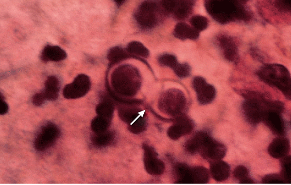 A 48-year-old man comes to the physician with a 6-month history of cough and fatigue.  He also has experienced malaise and weight loss.  He does not recall any sick contacts.  The patient is a carpenter.  He smokes 1 pack of cigarettes daily.  Temperature is 37.1 C (98.8 F) .  Examination shows left lower lobe crackles.  HIV testing is negative.  Chest x-ray reveals a pulmonary infiltrate in the lower lobe of the left lung.  Results from sputum potassium hydroxide preparation are shown below.   Which of the following is the most likely cause of this patient's condition? A) Aspergillus fumigatus B) Blastomyces dermatitidis C) Candida albicans D) Coccidioides immitis E) Cryptococcus neoformans F) Histoplasma capsulatum G) Rhizopus species