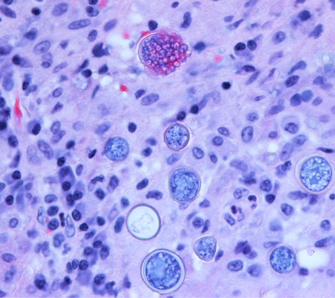 A 45-year-old man comes to the emergency department due to several days of cough and fever.  His temperature is 38.4 C (101.2 F) , blood pressure is 117/76 mm Hg, pulse is 92/min, and respirations are 18/min.  Physical examination of the right lung reveals occasional rales and decreased breath sounds at the base.  A chest x-ray demonstrates a lung infiltrate, hilar adenopathy, and a right-sided pleural effusion.  Lung tissue obtained from the patient reveals the findings in the image below:   Which of the following is the most likely cause of this patient's condition? A) Aspergillus fumigatus B) Blastomyces dermatitidis C) Coccidioides immitis D) Cryptococcus neoformans E) Cytomegalovirus F) Histoplasma capsulatum G) Rhizopus species H) Sporothrix schenckii