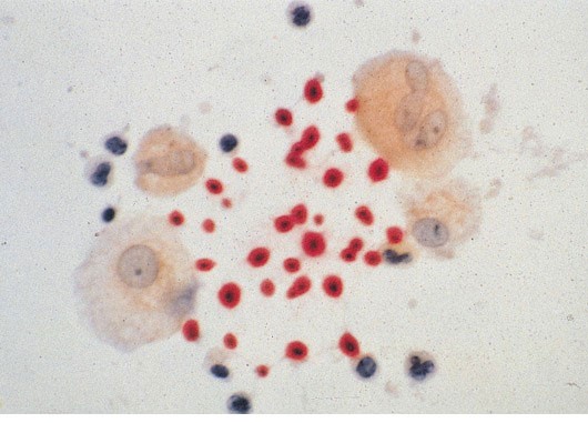 A 35-year-old man who received a kidney transplant one year ago comes to the emergency department with pleuritic chest pain and cough.  He is found to have a low-grade fever.  Chest x-ray reveals an infiltrate in the lower lobe of the right lung.  The patient is started on broad-spectrum antibiotics, including vancomycin, ceftriaxone, and azithromycin.  Despite these measures, his condition worsens over the next several days.  Bronchoscopy with bronchoalveolar lavage is performed.  Mucicarmine staining of his bronchoalveolar fluid reveals the following on light microscopy:   Which of the following is the most likely cause of this patient's condition? A) Aspergillus fumigatus B) Blastomyces dermatitidis C) Candida albicans D) Coccidioides immitis E) Cryptococcus neoformans F) Histoplasma capsulatum G) Rhizopus species