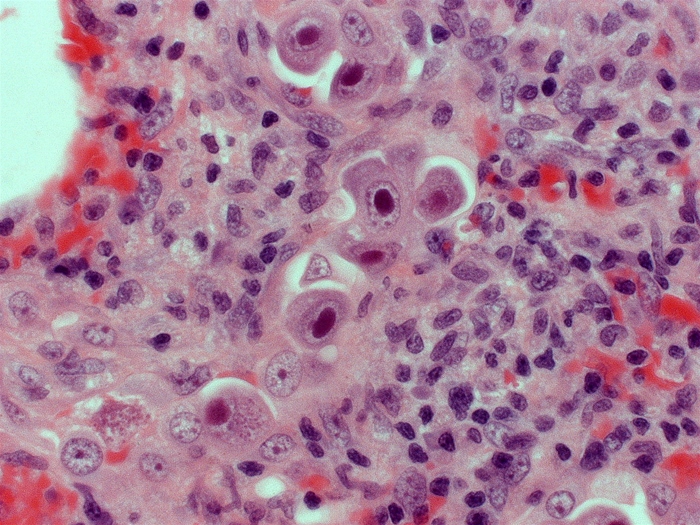 A 53-year-old man comes to the emergency department due to progressively worsening shortness of breath, nonproductive cough, and low-grade fevers over the past 2 weeks.  He has not had a runny nose or sore throat and does not recall any sick contacts.  He received a lung transplant for idiopathic pulmonary fibrosis 4 months ago.  His medications include immunosuppressants and trimethoprim-sulfamethoxazole.  Temperature is 37.8 C (100 F) .  Chest x-ray reveals diffuse interstitial infiltrates bilaterally.  A decrease in pulmonary function is noted on testing.  A lung biopsy specimen is shown below.   Which of the following best characterizes the organism most likely responsible for this patient's current condition? A) Enveloped double-stranded DNA virus B) Enveloped single-stranded RNA virus C) Filamentous gram-positive rods D) Nonenveloped double-stranded DNA virus E) Nonenveloped single-stranded RNA virus F) Trophic and cystic fungal forms