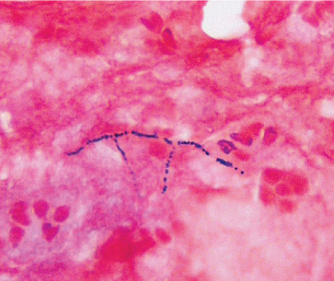 A 54-year-old woman is sent to the emergency room after having a widespread tonic-clonic seizure. During the preceding week, the patient experienced a fever, nocturnal sweats, lethargy, and a severe cough. She had a kidney transplant two years ago and is on immunosuppressive medicine. She is febrile and postictal on examination. There are sporadic lung crackles as well as typical heart sounds. The leukocyte count is high, and a chest x-ray shows patchy bronchopneumonia with numerous nodules. Multifocal abscesses are seen on brain imaging. As illustrated below, sputum Gram stain displays filamentous, branching gram-positive rods:   This pathogen is likely to demonstrate which of the following characteristics? A) Anaerobic growth B) Angioinvasion C) Intracellular multiplication D) Partial acid fastness E) Phospholipase production