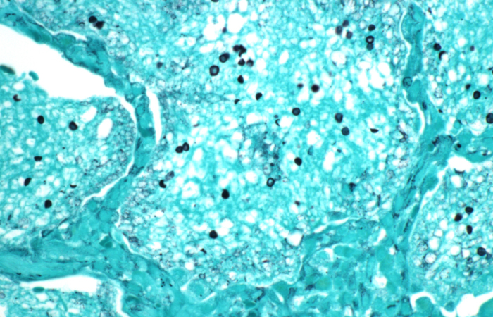 A 32-year-old woman arrives to the emergency room with a worsening cough, shortness of breath, and low-grade fevers that had persisted for four weeks. She has also lost 4.5 kg (10 lb)  unintentionally during the last three months. The temperature is 37.1 degrees Celsius (98.8 degrees Fahrenheit) , the blood pressure is 120/70 mm Hg, the pulse is 102/min, and the respirations are 22 per minute. On ambient air, pulse oximetry showed an 86 percent saturation. Auscultation of the lungs revealed bilateral crackles. There are no murmurs in the heart, and the jugular venous pressure is normal. An x-ray of the chest indicates widespread interstitial infiltrates. The patient has a bronchoscopy; the picture shows methenamine silver staining of the bronchoalveolar lavage material.   Which of the following is the most appropriate pharmacotherapy for this patient's current condition? A) Caspofungin B) Ceftriaxone and azithromycin C) Doxycycline D) Ganciclovir E) Trimethoprim-sulfamethoxazole F) Vancomycin