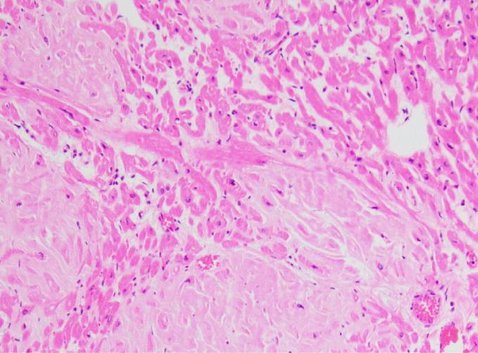 An 82-year-old man comes to the office due to progressive dyspnea and fatigue over the last year, which now limit his daily activities.  He has also noticed bilateral swelling of his feet.  The patient has hypertension, which is controlled with amlodipine.  His blood pressure is 122/72 mm Hg and pulse is 55/min.  Physical examination reveals elevated jugular venous pressure with rapid 'y' descent and a prominent S4.  Abdominal examination shows moderate ascites.  The patient has 3+ bilateral lower extremity pitting edema.  Echocardiogram reveals left atrial enlargement with marked left ventricular hypertrophy and normal left ventricular ejection fraction.  Complete blood count and basic metabolic panel are within normal limits.  Endomyocardial biopsy findings are shown below.   Which of the following is the most likely diagnosis? A) Cardiac myxoma B) Cardiac sarcoidosis C) Chagas disease D) Hemochromatosis E) Senile amyloidosis