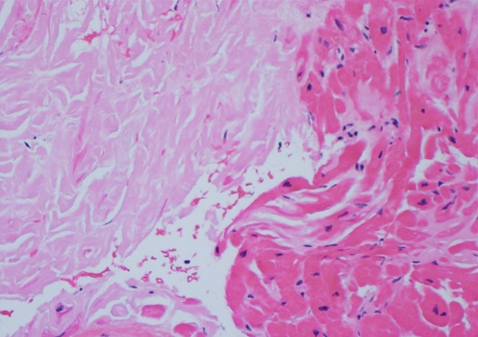 A 65-year-old man is evaluated for progressive shortness of breath.  He has had exertional dyspnea for the past year and has been experiencing weight gain and peripheral edema for the last several weeks.  He has no previous history of cardiac or pulmonary disease.  Cardiac biopsy of the left ventricle shows the histopathologic findings on the slide below.   Which of the following are the most likely echocardiographic findings in this patient?   A) A B) B C) C D) D E) E