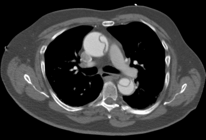 A 56-year-old man comes to the emergency department with acute, severe chest pain.  His electrocardiogram is within normal limits.  Contrast-enhanced computed tomography of his chest is shown below.   Which of the following is the single most important risk factor for this patient's current condition? A) Diabetes mellitus B) High cholesterol C) Hypertension D) Limited physical activity E) Smoking F) Spirochete infection