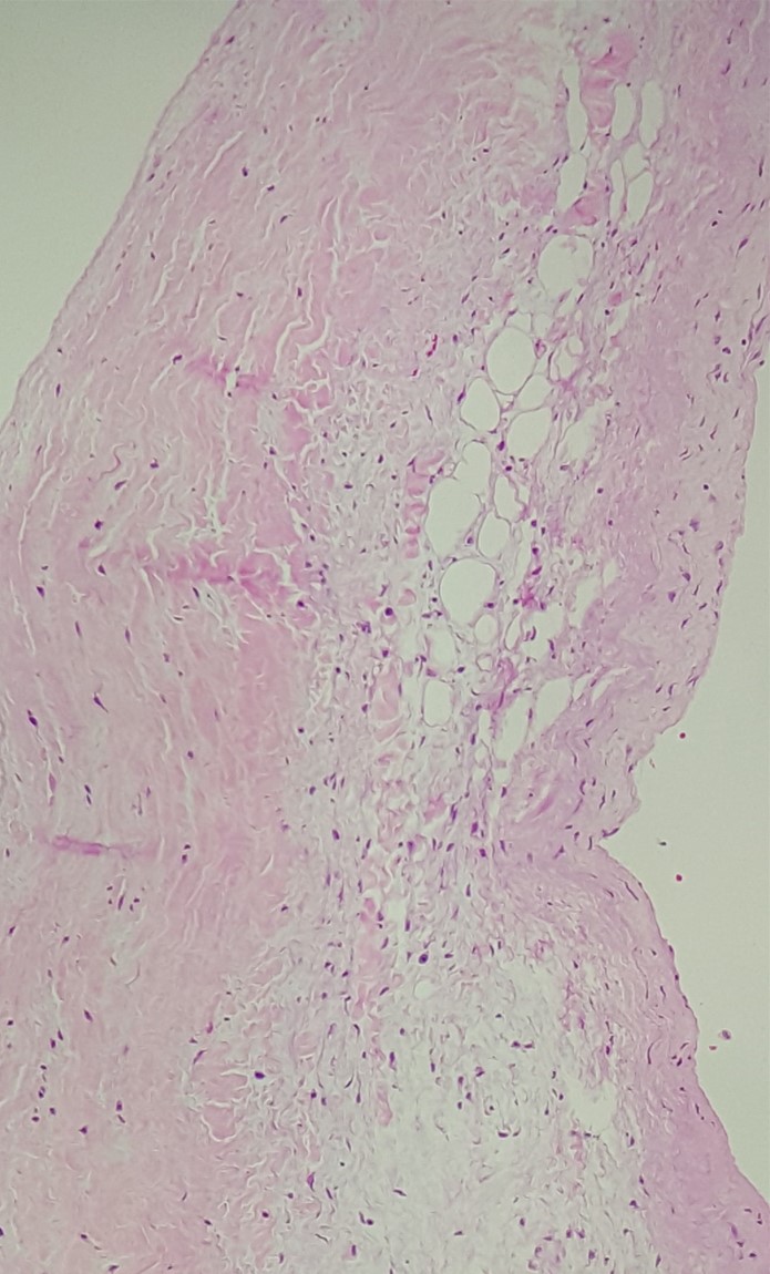 A 50-year-old man is brought to the emergency department due to chest pain.  He passed out briefly after the pain started.  Medical history includes hypertension, hyperlipidemia, and early-stage chronic kidney disease.  The patient reports that his father had a heart attack at a young age.  Despite treatment, the patient dies during hospitalization.  An autopsy is performed.  Light microscopy of the aortic wall is shown on the slide below.   Which of the following underlying mechanisms is most likely responsible for this patient's disease process? A) Atherosclerosis B) Calciphylaxis C) Cystic degeneration of the media D) Granulomatous inflammation E) Monckeberg sclerosis