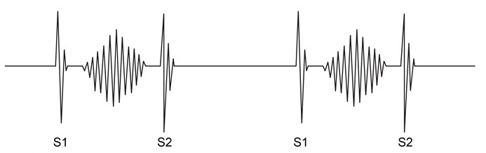 A 74-year-old man comes to the office for a follow-up visit for hypertension.  His last visit was a year ago.  He has no chest pain, shortness of breath, leg swelling, or dizziness.  The patient is compliant with his medications and can tolerate a moderate level of physical activity.  Blood pressure is 145/75 mm Hg and pulse is 67/min and regular.  Auscultation findings at the base of the heart are depicted in the exhibit below.   Which of the following is the most likely cause of this patient's physical findings? A) Ankylosing spondylitis B) Chordal rupture C) Coronary artery disease D) Cystic medial necrosis E) Infective endocarditis F) Rheumatic fever G) Right ventricular failure H) Valvular calcification