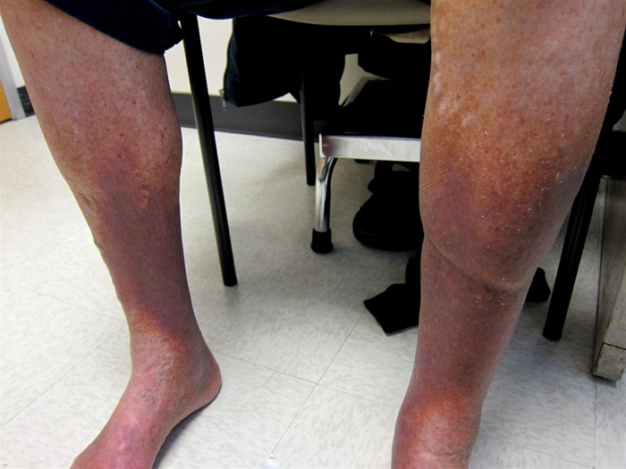 A 68-year-old man comes to the office to establish care.  He has type 2 diabetes mellitus complicated by chronic kidney disease and peripheral sensory neuropathy.  Medical history is notable for hypertension and coronary artery disease.  The patient works for an agricultural supply company and spends most of his day walking and standing on the warehouse floor.  Vital signs are normal.  BMI is 34 kg/m<sup>2</sup>.  Examination of the lower extremities shows decreased sensation to monofilament testing below the knees bilaterally, with 2+ pitting edema, varicosities, and extensive discoloration, as shown below.   Which of the following is the most likely cause of the discoloration in this patient's skin? A) Arteriolar calcium phosphate deposition B) Cutaneous fungal infection C) Glycosaminoglycan accumulation D) Hemosiderin deposition E) Increased melanin production