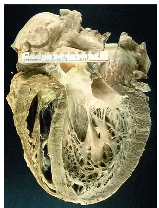 A 42-year-old man comes to the emergency department due to fatigue and exertional dyspnea.  Over the last 2 weeks his symptoms have progressively worsened to the point that he can no longer walk across his living room without becoming short of breath.  He is admitted to the hospital but dies suddenly despite aggressive treatment.  An autopsy is performed, and a cross-section of his heart is shown in the image below.   This patient's symptoms were most likely caused by which of the following mechanisms? A) Decreased ventricular contraction force B) Dynamic left ventricular outflow obstruction C) Impaired left ventricular filling D) Increased pulmonary vascular resistance E) Poor ventricular wall compliance