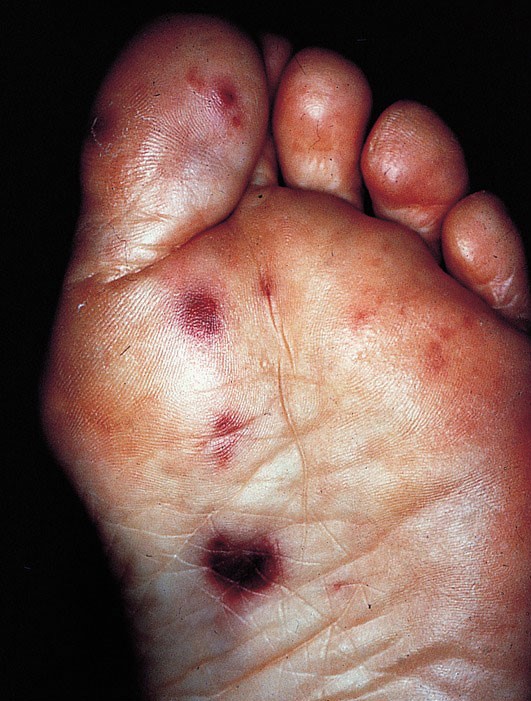 A 32-year-old man is brought to the emergency department with a several-day history of high-grade fever, dyspnea, and fatigue.  The patient's temperature is 39.4 C (102.9 F) , blood pressure is 122/70 mm Hg, and pulse is 102/min and regular.  Physical examination reveals a new holosystolic murmur with a blowing quality that is best heard over the cardiac apex.  Skin examination shows nontender lesions on the sole of the feet, as shown in the image below.   Which of the following do these lesions most likely represent? A) Areas of local vascular growth B) Foci of granulomatous inflammation C) Immune complex-mediated vascular lesions D) Microemboli to skin vessels E) Primary infection foci