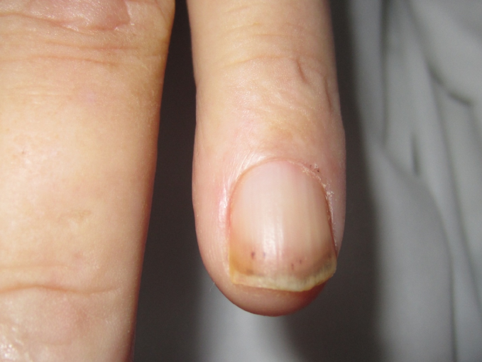 A 24-year-old woman comes to the physician with a 3-week history of progressive fatigue.  Physical examination shows lesions involving the nail beds, as seen in the photograph below.   Further evaluation would most likely reveal additional abnormalities during which part of the physical examination? A) Neck palpation B) Lung auscultation C) Cardiac auscultation D) Abdominal palpation E) Rectal examination