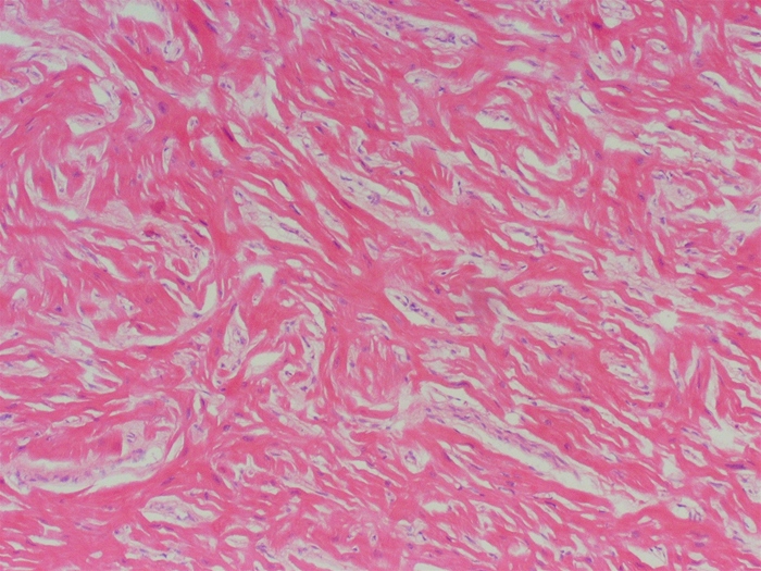 A 20-year-old student collapses suddenly in class and dies, despite resuscitation efforts.  Review of the medical chart is conducted-including symptoms, review of systems, medical history, and substance use-and is unremarkable except for a family history of sudden cardiac death.  Autopsy is performed and myocardial histology is shown in the image.  Complete genotyping is most likely to reveal a pathologic mutation that affects a protein belonging to which of the following structures?   A) Cell junction complex B) Ion channel C) Mitochondria D) Nuclear envelope E) Sarcomere