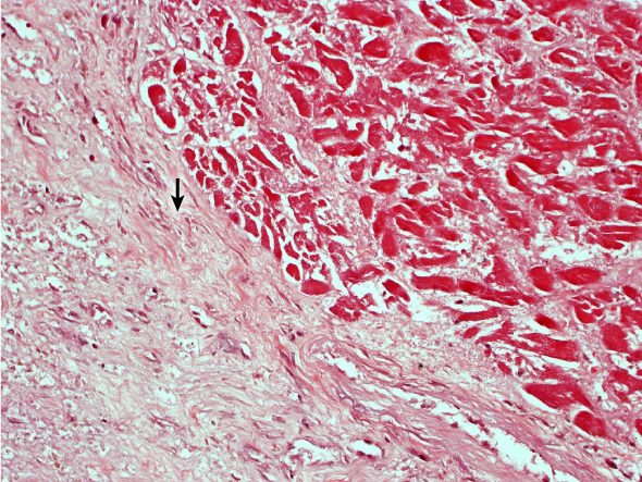 A 62-year-old man dies suddenly in his sleep.  The patient had a history of type 2 diabetes mellitus and hypertension, and he smoked a pack of cigarettes daily for 25 years.  His adherence to medical care was poor.  Autopsy is performed, and a histologic section of his left ventricular myocardium is shown below:   Which of the following directly promotes the formation of the tissue indicated by the arrow? A) Endothelium-derived relaxing factor B) Interferon-beta C) Interleukin-8 D) Transforming growth factor-beta E) Tumor necrosis factor-alpha