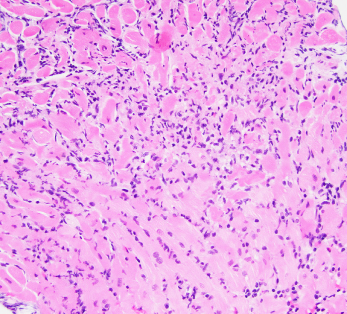 A 38-year-old man dies suddenly at his workplace and cannot be resuscitated.  He had experienced chest discomfort, shortness of breath, and fatigue in the week preceding the event.  The man was overweight but otherwise had no significant medical history.  He had no established primary care physician.  He did not use alcohol, tobacco, or illicit drugs.  Both parents are alive and healthy; a maternal uncle reportedly died of a heart attack at age 50.  Autopsy was performed and myocardial findings are shown in the slide below.   Which of the following is the most likely diagnosis? A) Acute myocarditis B) Cardiac amyloidosis C) Congenital long QT syndrome D) Early-onset coronary artery disease E) Hypertrophic cardiomyopathy