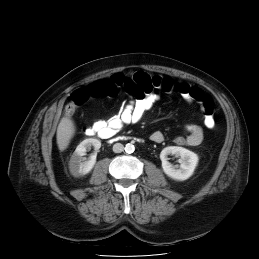 A 64-year-old man comes to the emergency department due to flank discomfort and red urine.  He has a history of hypertension and type 2 diabetes mellitus.  Three months ago, the patient had an ischemic stroke and now has mild, residual, right-sided weakness.  Serum creatinine is 0.9 mg/dL, and serum lactate dehydrogenase is elevated.  Urine microscopy shows many red blood cells.  The findings of a CT scan of the abdomen with contrast are shown in the image below:   Which of the following is the most likely cause of this patient's symptoms? A) Atrial fibrillation B) Deep venous thrombosis of the lower extremities C) Focal segmental glomerulosclerosis D) Hypersensitivity interstitial nephritis E) Pulmonary hypertension