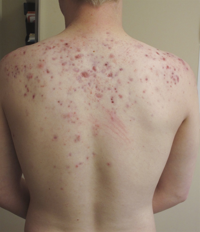 A 17-year-old boy comes to the office for evaluation of a rash.  For the past 2 years, the patient has had recurrent skin bumps that are frequently red and painful.  He has no other medical conditions and takes no medications.  Vital signs are within normal limits.  Skin examination findings are shown below.   This patient's skin condition primarily affects which of the following structures? A) Dermal papillae B) Eccrine sweat glands C) Epidermal-dermal junction D) Melanocytes E) Pilosebaceous follicles F) Subcutaneous adipose tissue