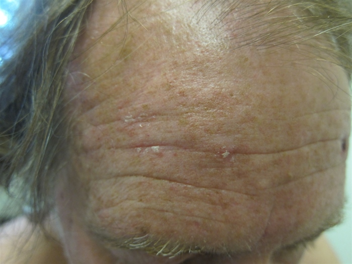 A 58-year-old man comes to the physician for evaluation of skin lesions on his forehead.  He says that he first noticed the lesions when he was rubbing his forehead because of their roughness.  His medical problems include hypertension that is well controlled with chlorthalidone.  He has worked as a construction foreman for 32 years.  Physical examination shows the findings seen in the image below.   Which of the following is the most likely diagnosis? A) Actinic keratosis B) Atopic dermatitis C) Pityriasis rosea D) Psoriasis E) Seborrheic keratosis