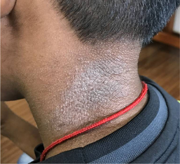 A 12-year-old child is brought to the clinic with a rash on the back of his neck. The patient has had this rash on and off for several years. With the cooler season, the rash has gotten more pruritic in the previous two months, and the patient is continuously itching his neck. There are no additional medical issues or drugs that the patient is taking. Vital indicators are typical. The picture below depicts the posterior neck.   Which of the following is the most likely cause of this patient's rash? A) Cutaneous infection with mites B) Cutaneous infection with Trichophyton rubrum C) Genetically mediated skin barrier dysfunction D) Hormone-mediated keratinocyte and dermal fibroblast proliferation E) Proliferation of atypical keratinocytes due to p53 mutation