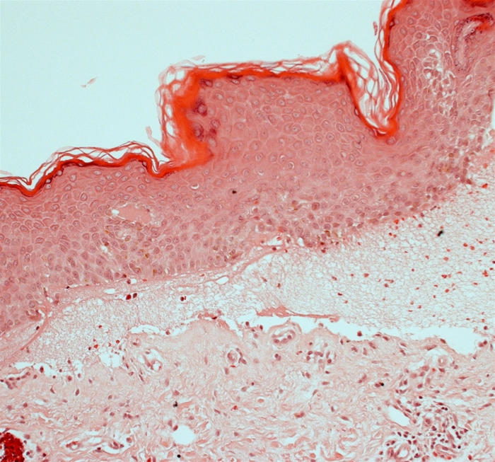 A 64-year-old man comes to the office due to blisters on his trunk and groin.  Itching has occurred for the past several weeks, and blisters developed a week ago.  He has a history of hypertension and osteoarthritis.  The patient received the zoster vaccine at age 60.  Examination shows numerous 0.5- to 3-cm bullous skin lesions.  The findings from a skin biopsy are shown in the image below:   Which of the following is the most likely diagnosis? A) Bullous pemphigoid B) Contact dermatitis C) Dermatitis herpetiformis D) Lichen planus E) Pemphigus vulgaris