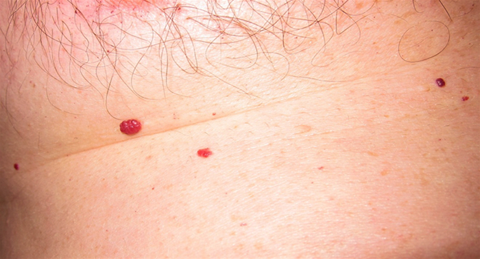 A 35-year-old man comes to the office for evaluation of red skin lesions under his nipple that were first noticed by his wife.  The lesions are not itchy or painful, and no other family members have skin lesions.  He has not used any new soaps, lotions, or detergents.  The patient has no known medical problems and takes no medications.  He drinks 4-6 beers every night.  He does not use tobacco or illicit drugs.  Body mass index is 32kg/m2, and vital signs are normal.  The skin findings are shown below.   Which of the following is the most likely diagnosis in this patient? A) Acrochordon B) Cavernous hemangioma C) Cherry hemangioma D) Cystic hygroma E) Spider angioma F) Strawberry hemangioma