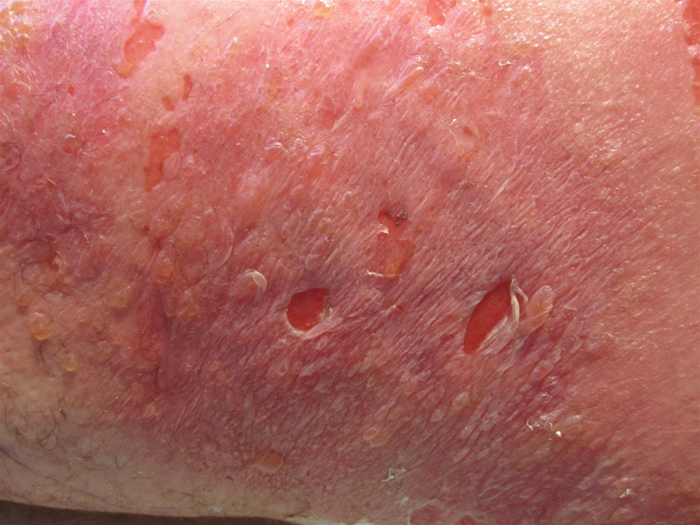A 53-year-old woman comes to the clinic due to a skin rash.  For the last 3 weeks, she has had a pruritic rash of worsening severity involving the posterior thighs.  The patient recently began an exercise program to lose weight and has been applying a topical analgesic cream to her thighs and buttocks after her workouts.  Her past medical history is unremarkable, and she does not use tobacco, alcohol, or illicit drugs.  On physical examination, there is an erythematous rash with blisters, ulcers, and weeping drainage involving the posterior thighs bilaterally, as shown in the image below.   Which of the following is the most likely finding on skin biopsy? A) Acanthosis B) Dyskeratosis C) Hypergranulosis D) Hyperkeratosis E) Spongiosis