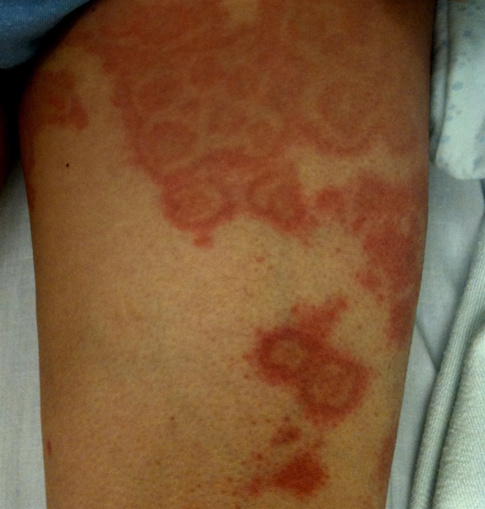 A 27-year-old woman comes to the emergency department with a 1-day history of skin rash.  Two weeks ago, she had an episode of recurrent genital lesions, which began with small papules and subsequently became vesicular with ulceration, crusting, and eventual healing.  The patient has no other medical conditions and takes no medications.  On physical examination, she appears comfortable.  Temperature is 37 C (98.6 F) .  She has small linear erosions in the oral mucosa.  Skin findings are shown in the image below.   Which of the following is the most likely diagnosis? A) Disseminated herpes simplex infection B) Erythema multiforme C) Primary HIV infection D) Stevens-Johnson syndrome E) Varicella