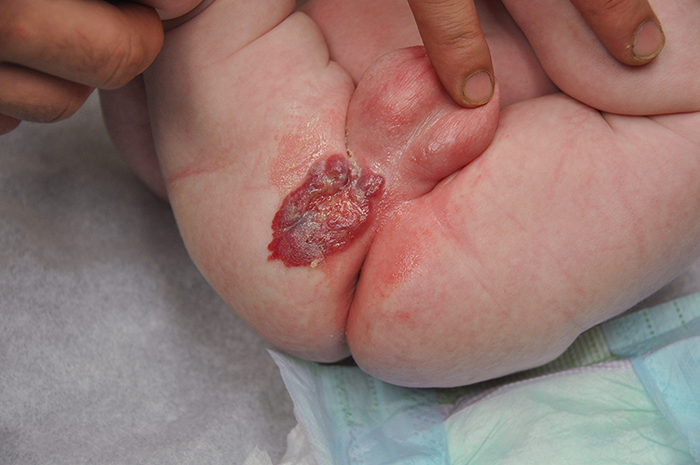 A 2-week-old boy has an elevated lesion over the genital area as seen in the image below:   Which of the following is the most likely natural course of this lesion? A) First increase and then regress in size B) First regress and then increase in size C) Progressively increase in size D) Progressively regress in size E) Remain stable in size