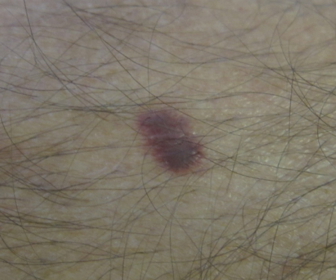 A 35-year-old man comes to the physician because of a skin rash.  Six months ago, the patient was treated in the hospital for Pneumocystis pneumonia and painful oral ulcers.  He takes no medications but drinks alcohol frequently and uses recreational drugs.  Physical examination demonstrates a widespread rash consisting of lesions similar to that shown in the image below.   Which of the following is the most likely cause of this patient's current condition? A) Arsenic exposure B) Cytomegalovirus C) Epstein-Barr virus D) Hepatitis C virus E) Herpes simplex virus type 1 F) Human herpesvirus type 8 G) Human papillomavirus H) Human T-cell leukemia virus type 1 I) Ultraviolet radiation J) Vinyl chloride exposure