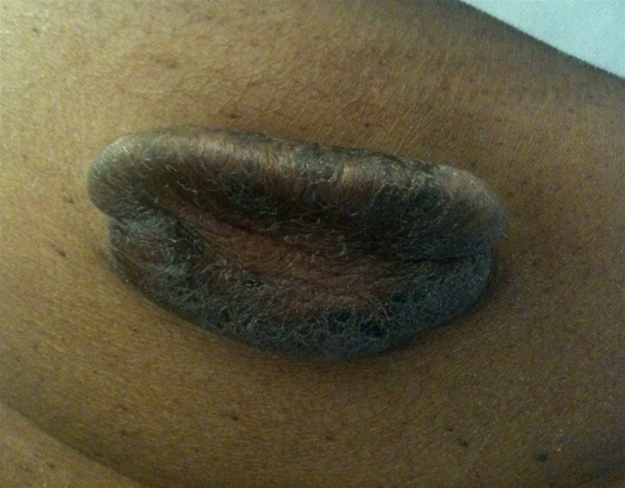 A 27-year-old woman comes to the emergency department with a scalp laceration after a fall.  She reports a tendency to develop big scars even with small injuries.  Physical examination reveals an old, healed laceration as shown in the image below.   Histochemical analysis of her tissue reveals fibroblasts that overexpress a cytokine essential for normal wound healing.  Which of the following substances is most likely involved? A) Interferon-β B) Interleukin-17 C) Nuclear factor-kappa B D) Transforming growth factor-β E) Tumor necrosis factor-α